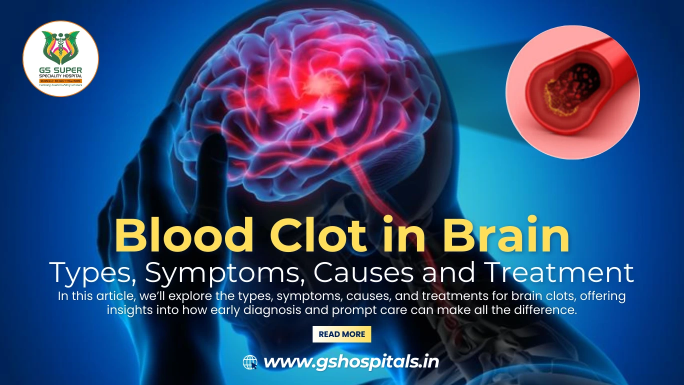 Blood Clot in Brain: Types, Symptoms, Causes and Treatment