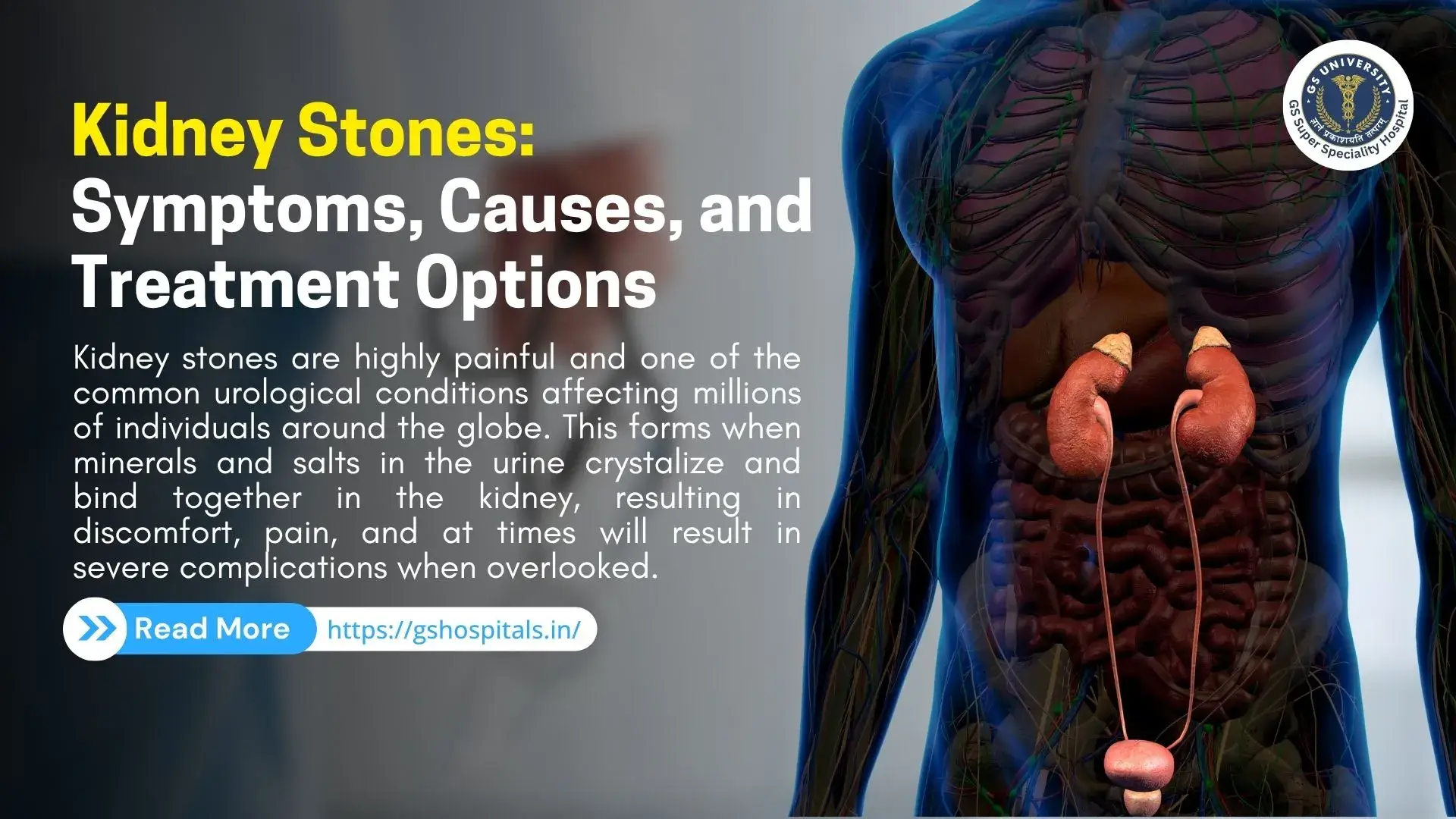 Kidney Stones: Symptoms, Causes, and Treatment Options  