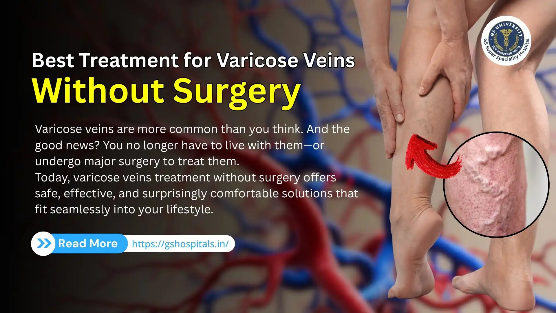 Best Treatment for Varicose Veins Without Surgery