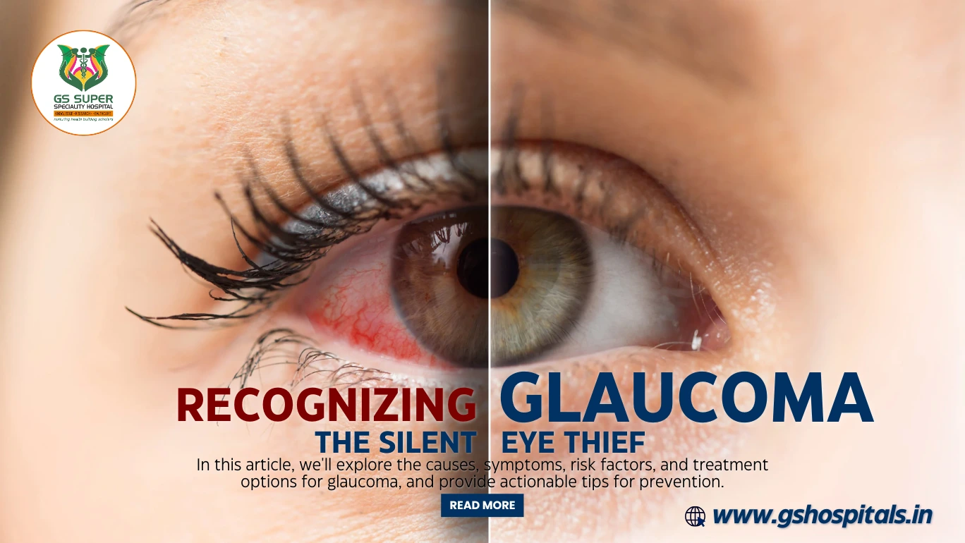 Recognizing Glaucoma: The Silent Eye Thief