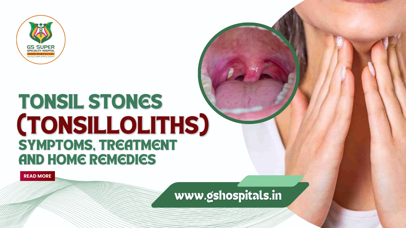 Tonsil Stones (Tonsilloliths): Symptoms, Treatment and Home Remedies