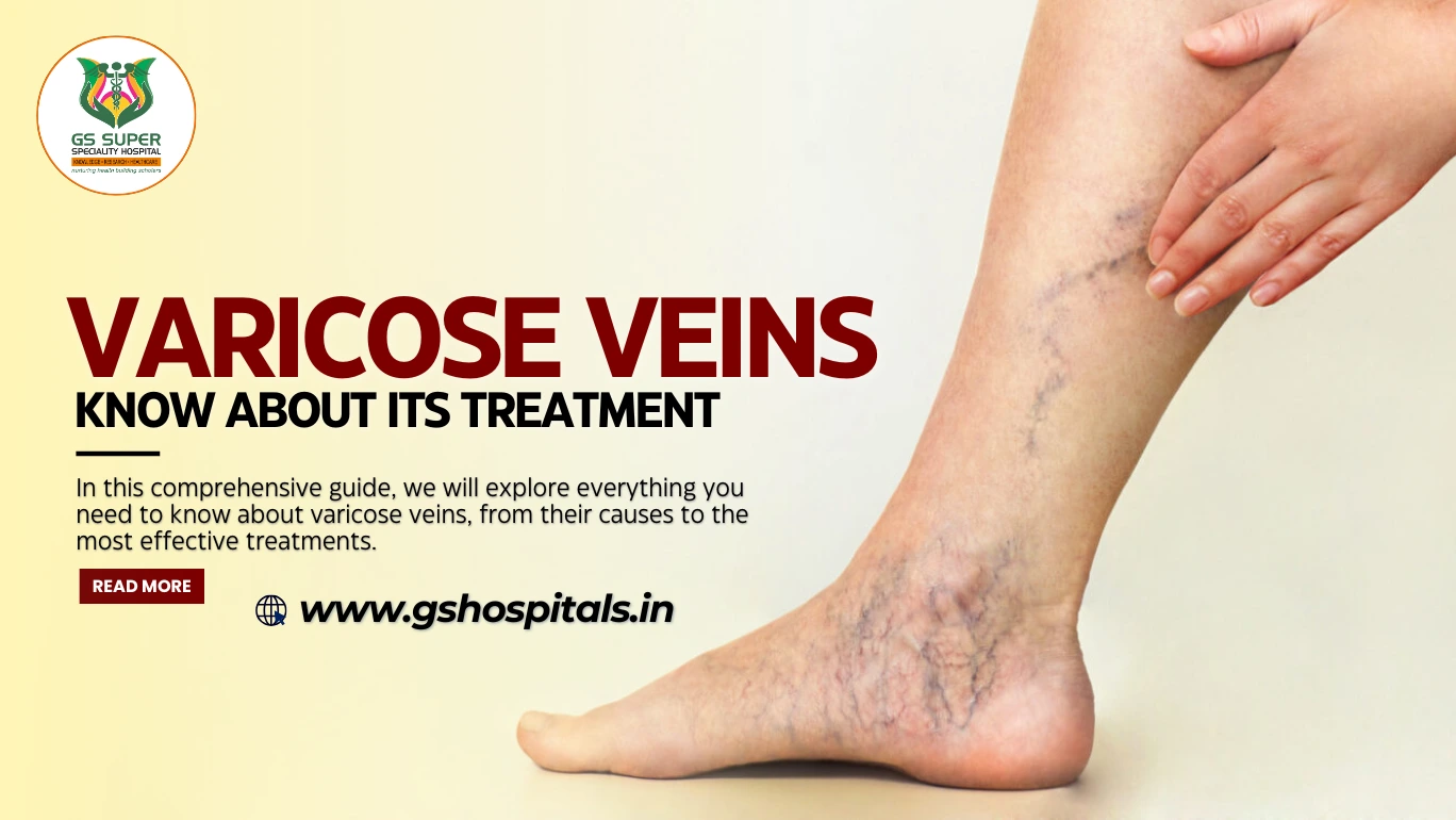 Varicose Veins: Know About Its Treatment